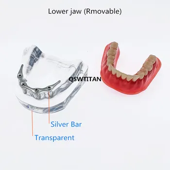 Zuby modelu s implantáty s Stříbrné Bar zubní Protéza Opravy Zuby mandibulární Zubní Výuky Model